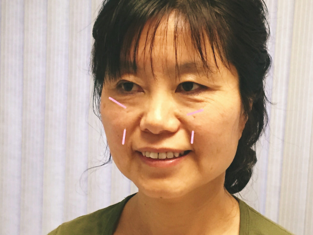 facial rejuvenation acupuncture