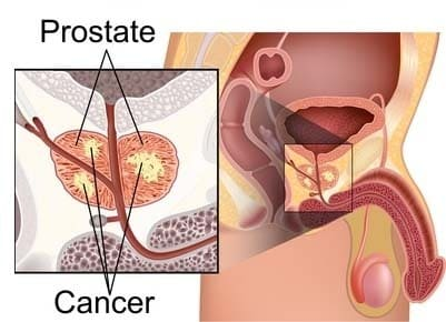 Erectile Dysfunction and Prostate Problems