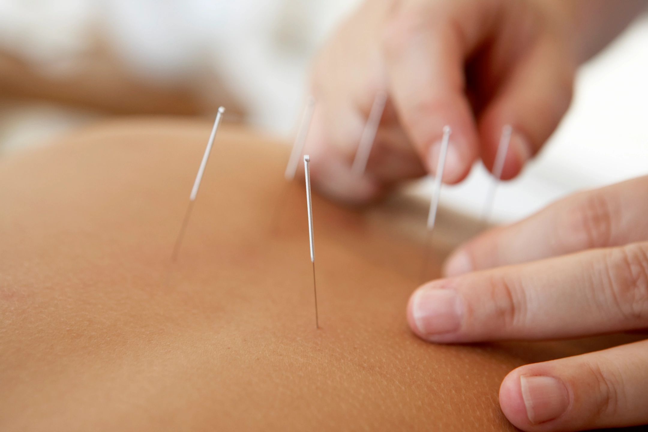 Latest Case Study - Acupuncture, Depression and Anxiety