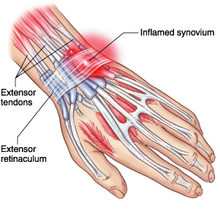 Case Study - Wrist Tendonitis